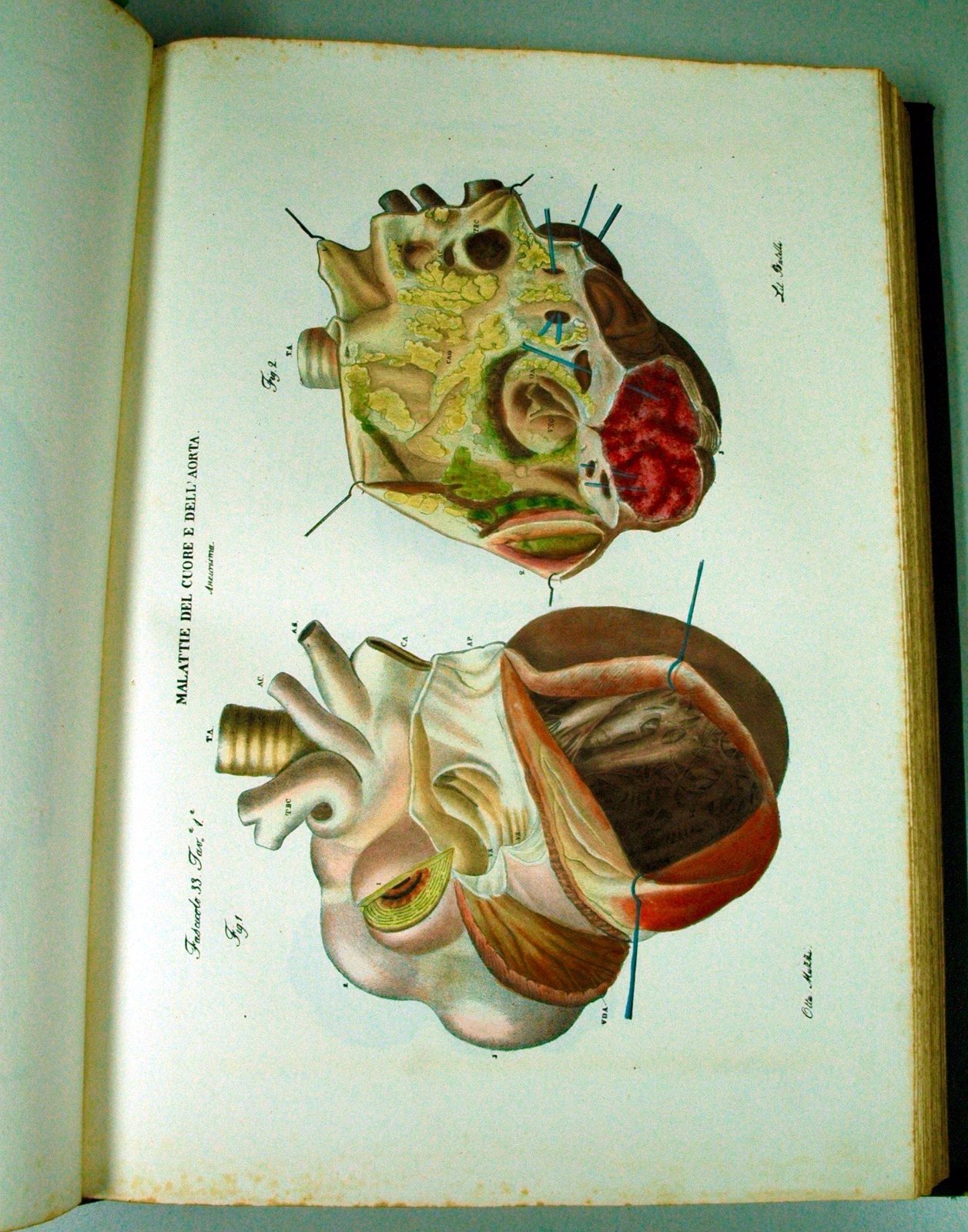 Jean Cruveilhier, Anatomia patologica del corpo umano