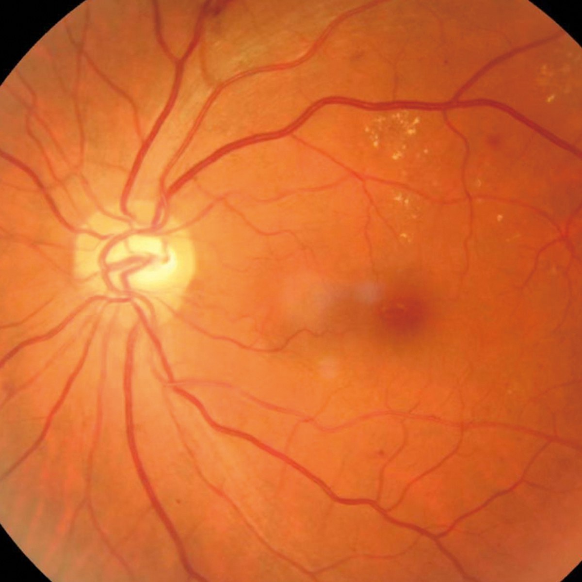 Retina con segni di retinopatia diabetica: piccole emorragie ed essudati giallastri vicino alla macula
