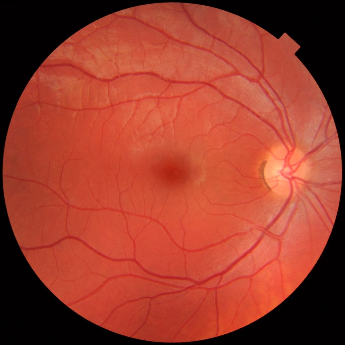 Fotografia di una retina sana: papilla ottica, macula e vasi sanguigni